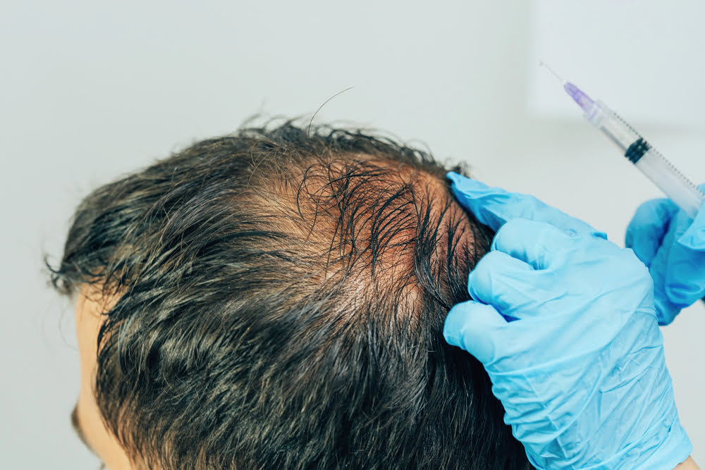 PRP-Behandlung für Haare